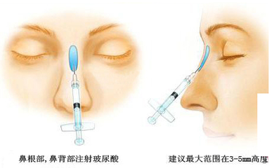 廣州哪個(gè)機(jī)構(gòu)隆鼻比較好呢