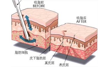 抽脂肪的原理圖