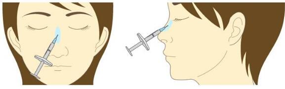 貴陽注射隆鼻的優(yōu)勢有哪些呢