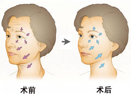 泉州做電波拉皮能維持多長時(shí)間