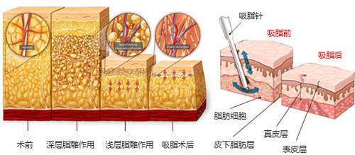 沈陽(yáng)做抽脂減肥術(shù)后有哪些護(hù)理工作