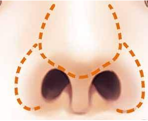 全鼻再造