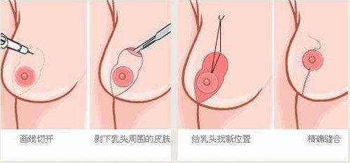 乳房下垂有些嚴重應(yīng)該怎么辦