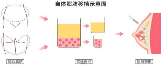 自體脂肪豐胸多久可以穩(wěn)定下來(lái)