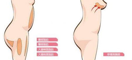 怎么進(jìn)行乳房再造