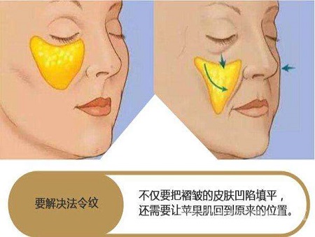 脂肪填充法令紋能維持多少時(shí)間？