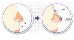 成都假體隆鼻手術(shù)的價格會很貴嗎