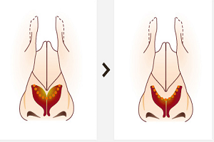 自體軟骨組織隆鼻有哪些優(yōu)點(diǎn)？
