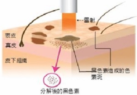 激光祛雀斑價(jià)格是多少呢