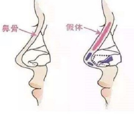 做假體隆鼻手術以后鼻子