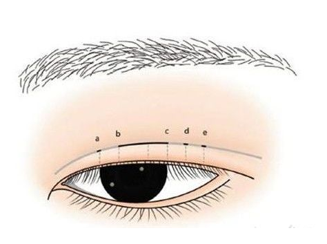 廈門割雙眼皮術(shù)后的疤痕能自然退掉么