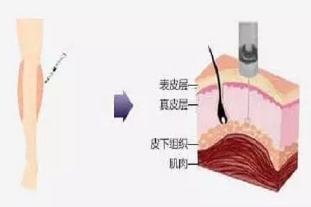 大腿部吸脂