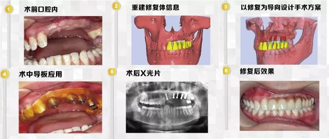 美萊數(shù)字化微創(chuàng)種植