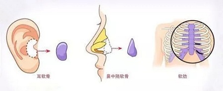 自體組織隆鼻