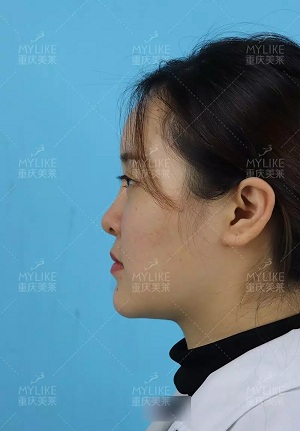 “鼻綜合”后假又歪，還攣縮？鼻修復(fù)還原自然生態(tài)美鼻