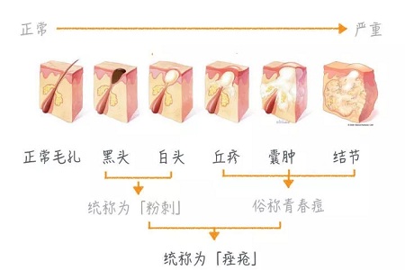 擠痘竟然被送進(jìn)ICU！你的痘痘還好嗎？