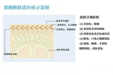 擠痘竟然被送進(jìn)ICU！你的痘痘還好嗎？