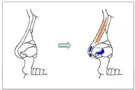 擔(dān)心鼻整形假體透光、發(fā)紅、移位？了解下自體軟骨