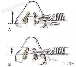 隆鼻手術(shù)切口在哪里？才能自然不留疤