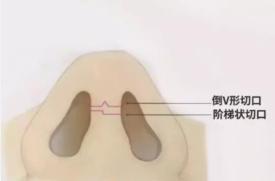 隆鼻手術(shù)切口在哪里？才能自然不留疤