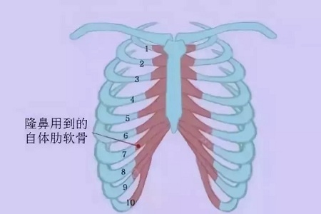 什么，隆鼻方式竟然有這么多種？