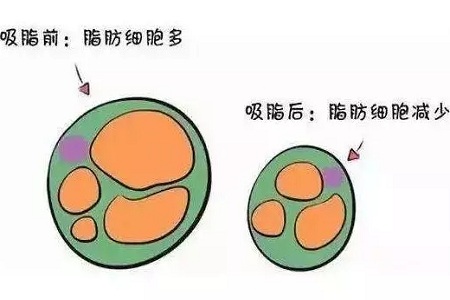 關(guān)于吸脂那些不能說的秘密，今天要在這里一次說完！