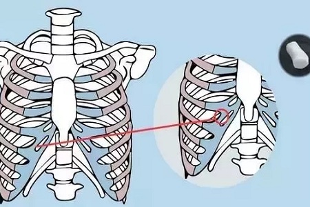 糾結(jié)！鼻頭太圓想塑形是用肋軟骨還是耳軟骨好？