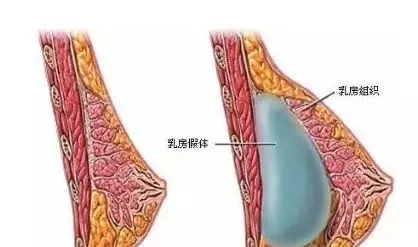 自體脂肪or假體隆胸，我到底應(yīng)該怎么選？