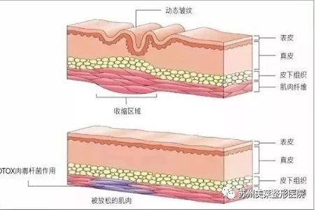 你無法用玻尿酸除掉所有皺紋！