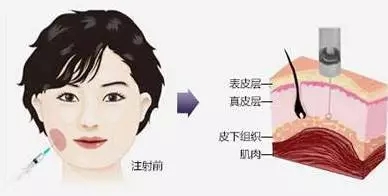 瘦臉會(huì)導(dǎo)致臉部凹陷松弛？