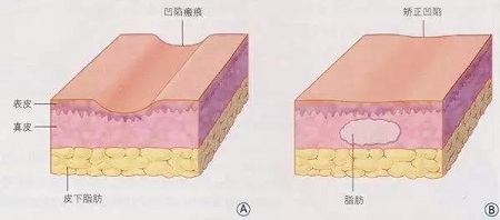 明星的臉和你的臉差的只是這一步！--面部脂肪填充