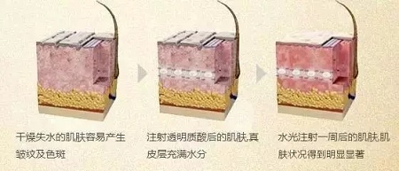 水光，打1次和4次究竟有多大區(qū)別？