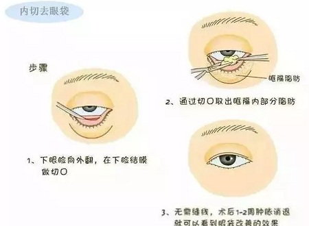 還把眼袋當(dāng)臥蠶？那就別怪小弟弟喊你阿姨了