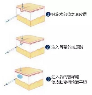 用玻尿酸治療鼻唇溝，一定要注意這種情況！