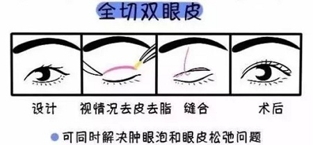 美眼張誠坐診美萊，淺談為什么你的眼睛不夠美？