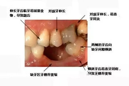 牙齒缺失時(shí)，選烤瓷牙還是那種？