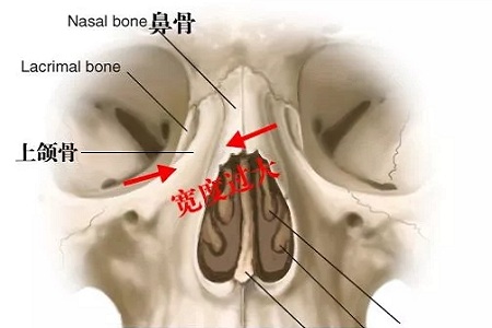 側(cè)面看鼻梁不矮,正面看鼻子卻很塌是什么原因？