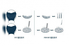 鄭州美萊 植發(fā)中心 毛發(fā)種植之原理篇