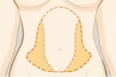 腰腹部吸脂