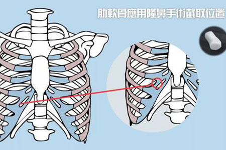 深圳隆鼻醫(yī)院做軟骨隆鼻多少錢