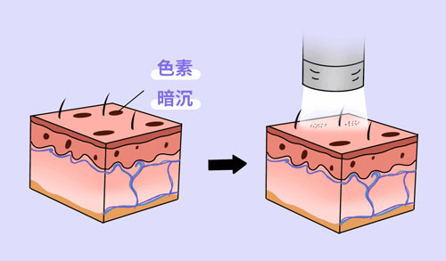 想要嫩膚，應(yīng)該選擇做光電還是水光